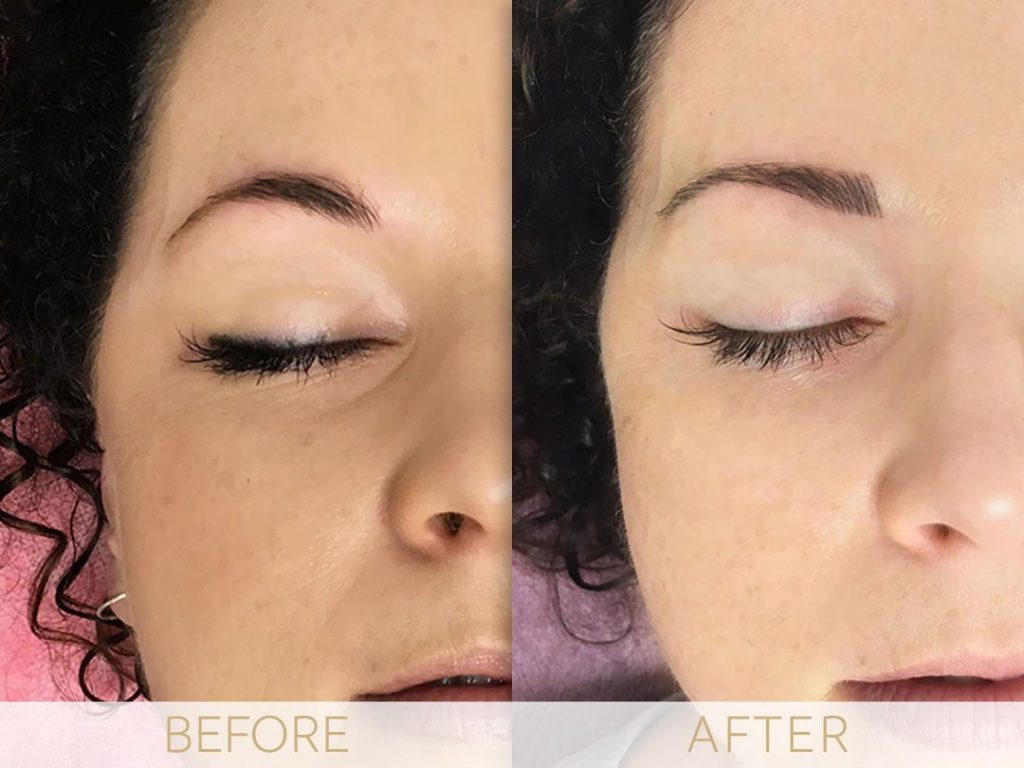 Micropigmentation before & after