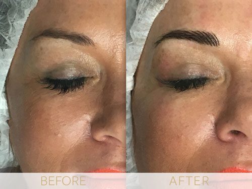 Micropigmentation before & after