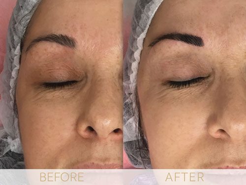 Micropigmentation before & after