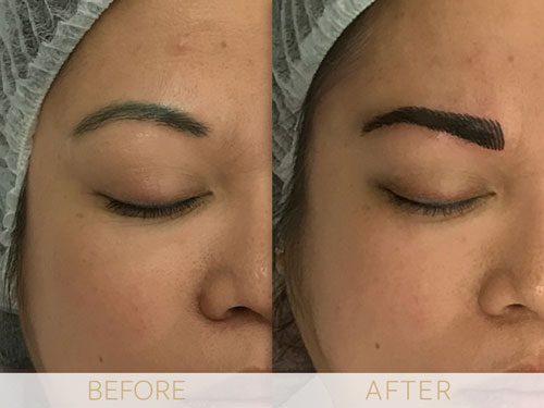 Micropigmentation before & after