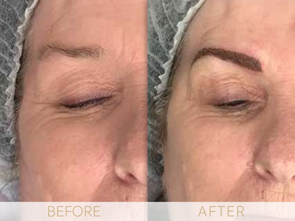 Micropigmentation before & after