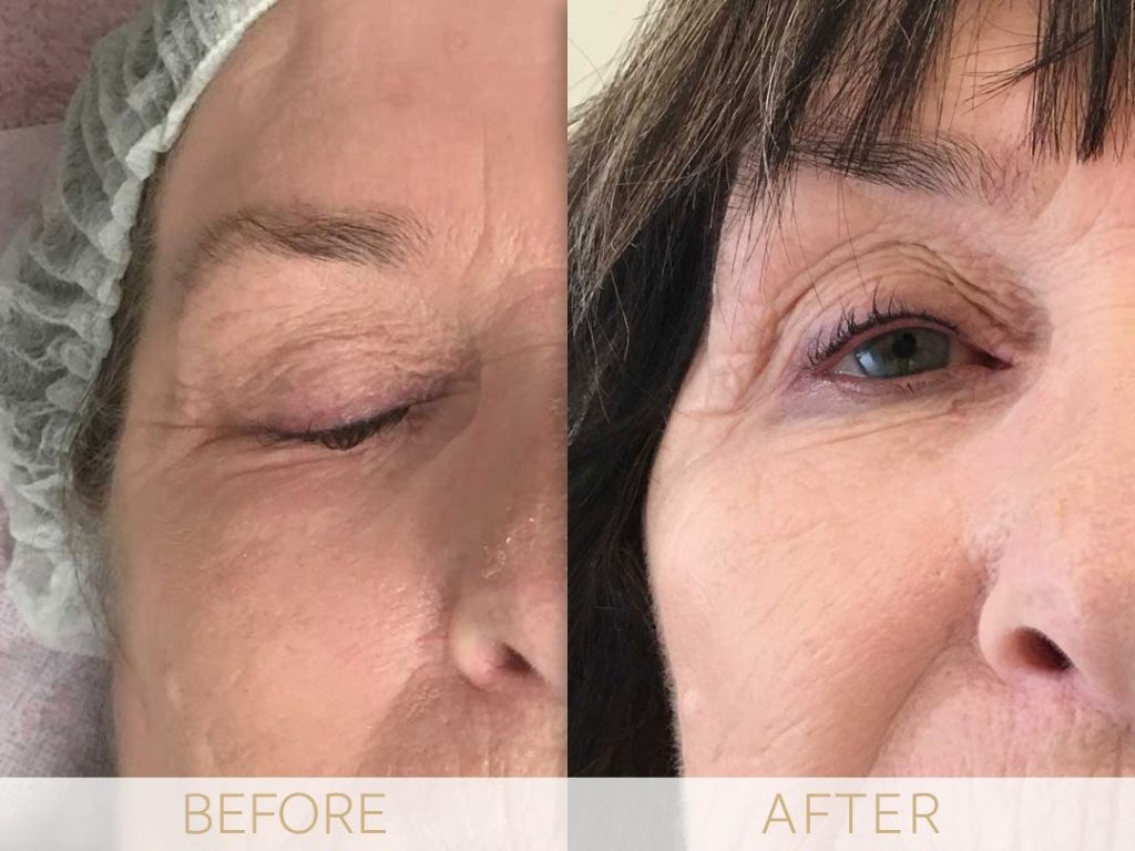 micropigmentation eye-ehancment, before & after