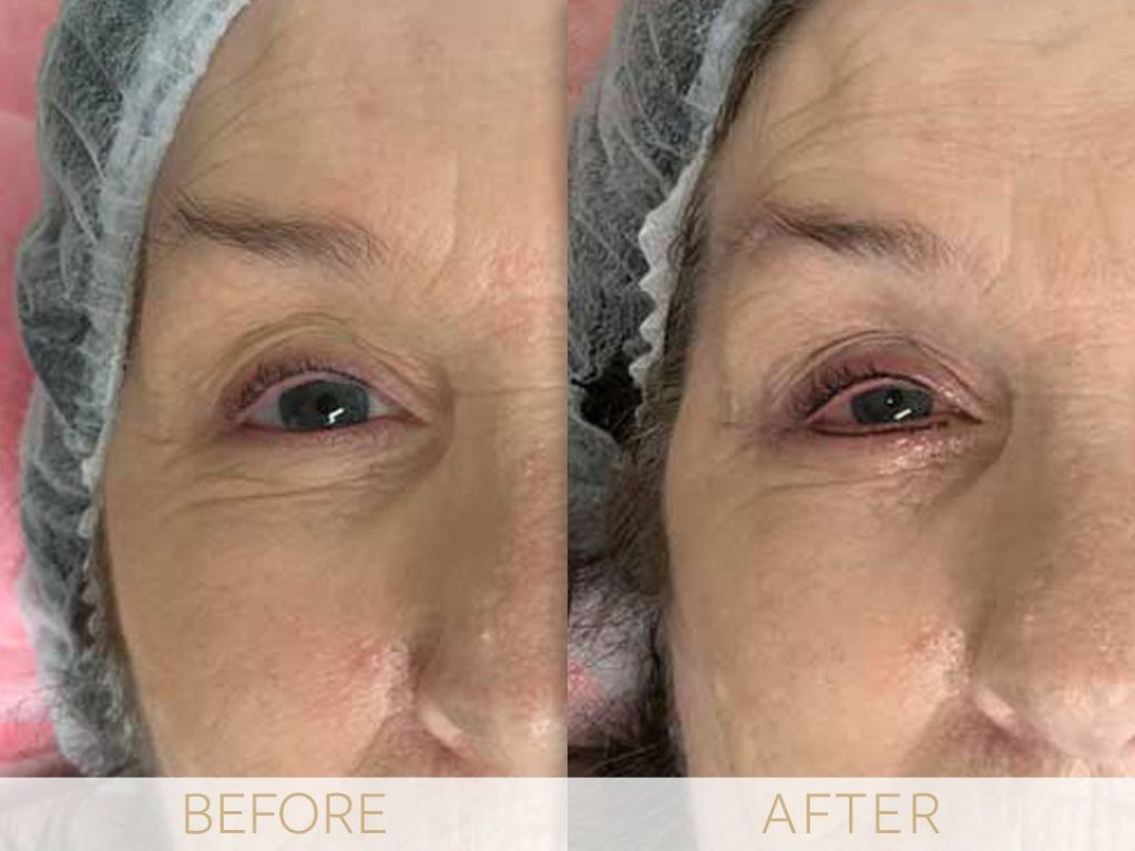 micropigmentation eye-ehancment, before & after