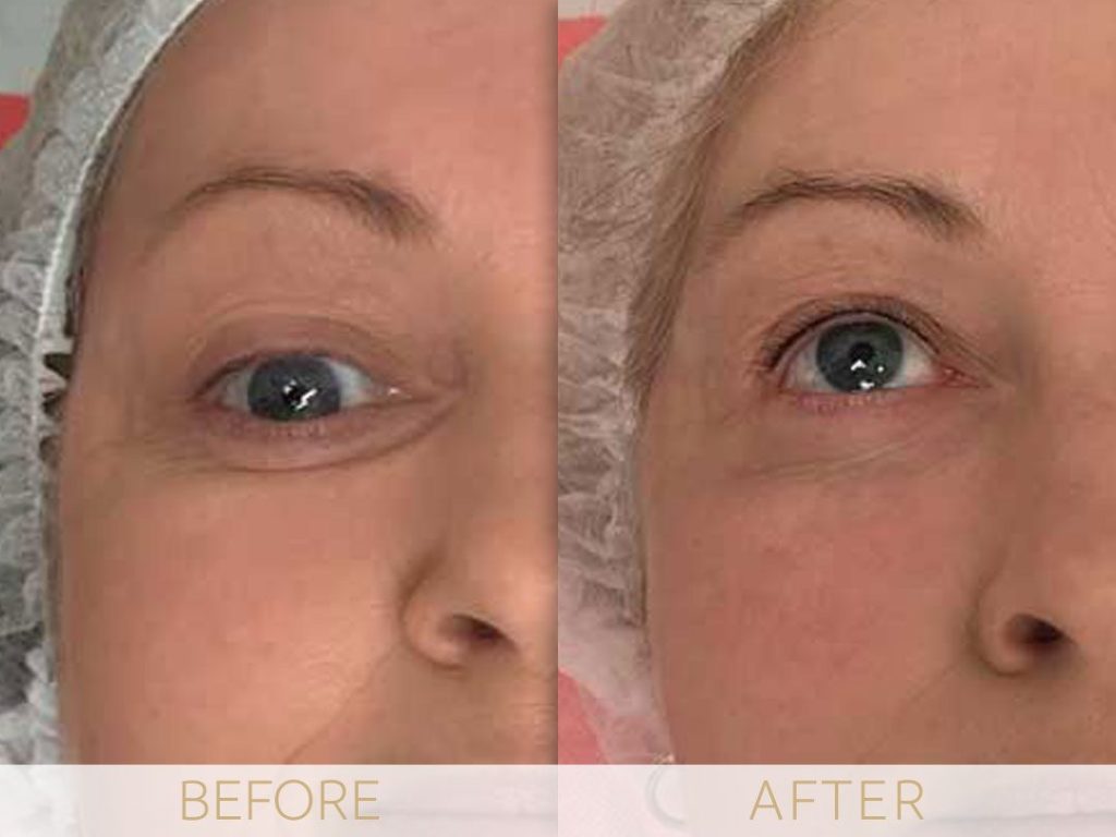 micropigmentation eye-ehancment, before & after