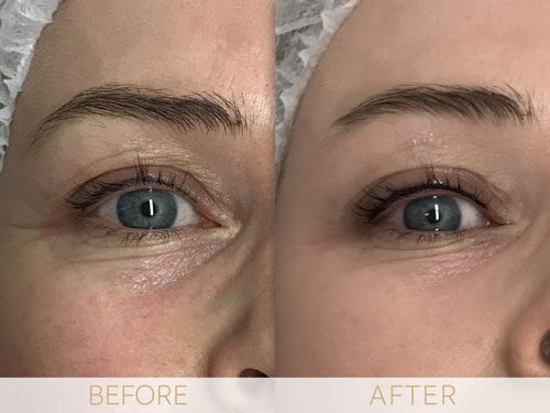 micropigmentation eye-ehancment, before & after