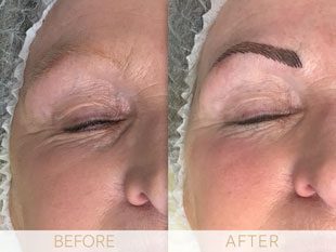 Micropigmentation before & after