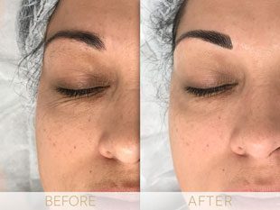 Micropigmentation before & after