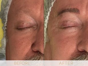 Micropigmentation before & after