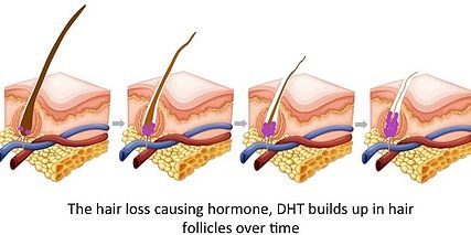 Hair-loss-DHT-buildup-diagram – Acacia Skin Health & Beauty