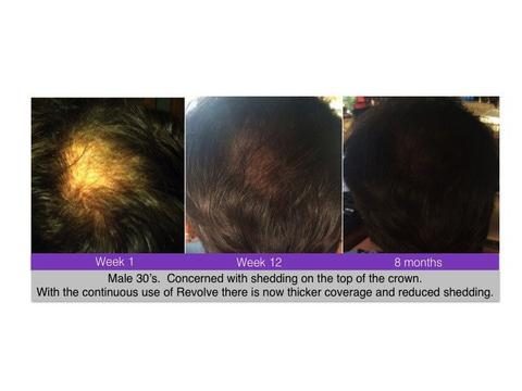 hair restore before and after