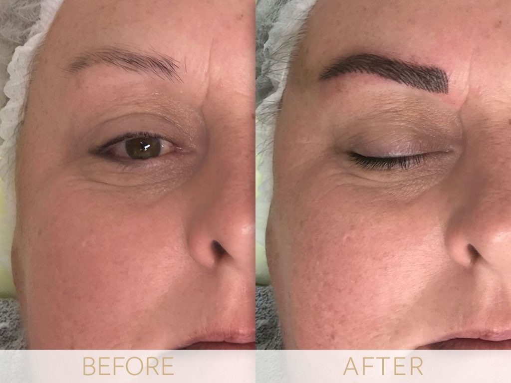 Micropigmentation before & after