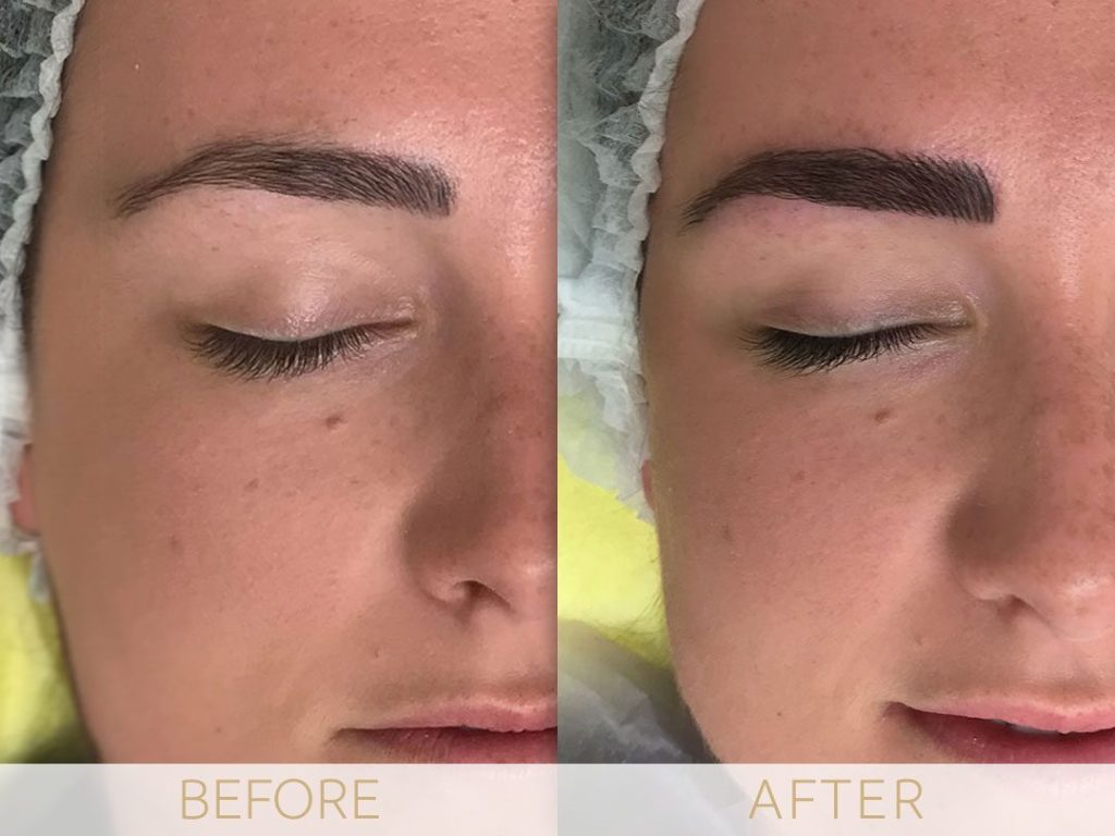 Micropigmentation before & after