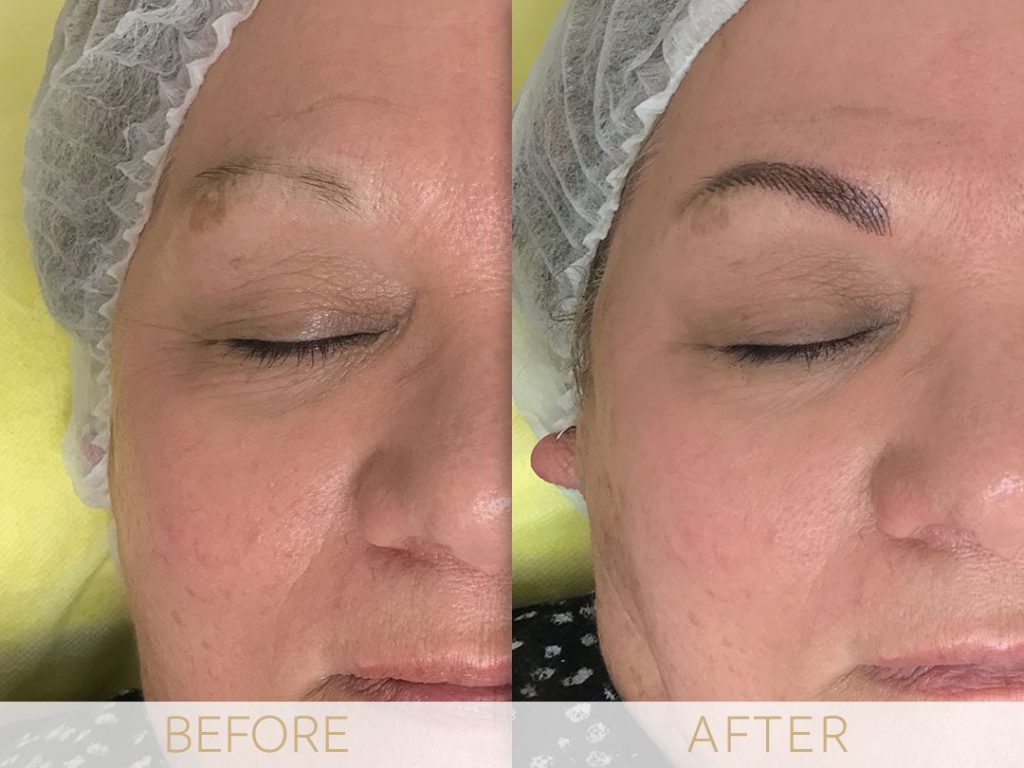 Micropigmentation before & after