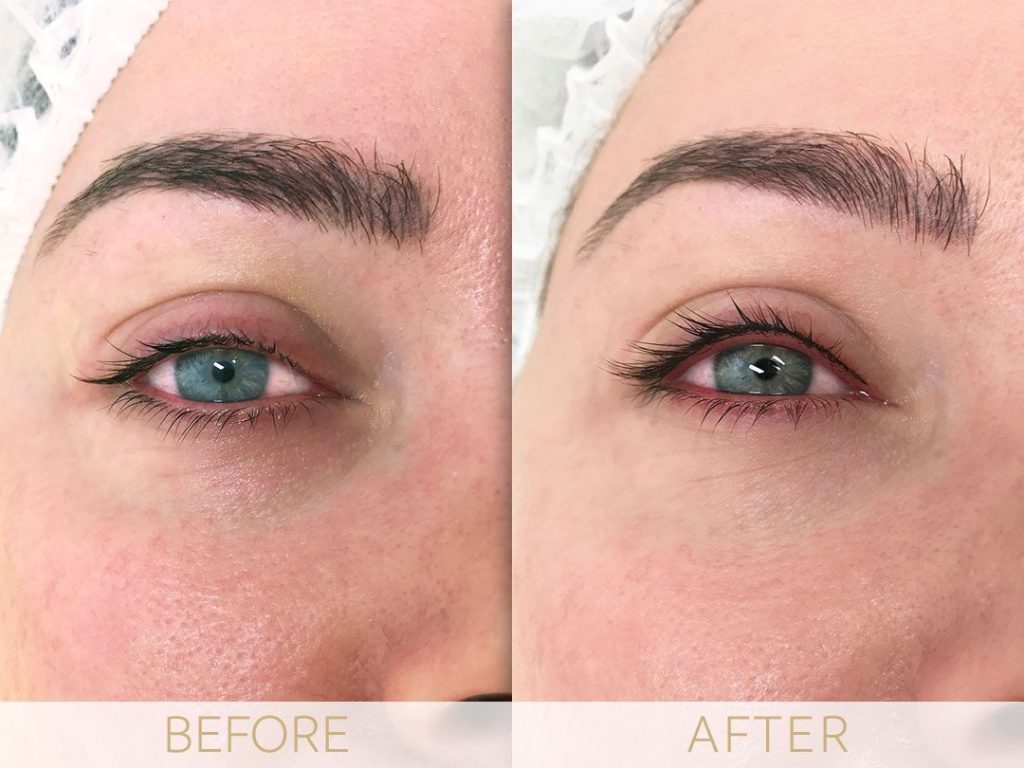 micropigmentation eye-ehancment, before & after