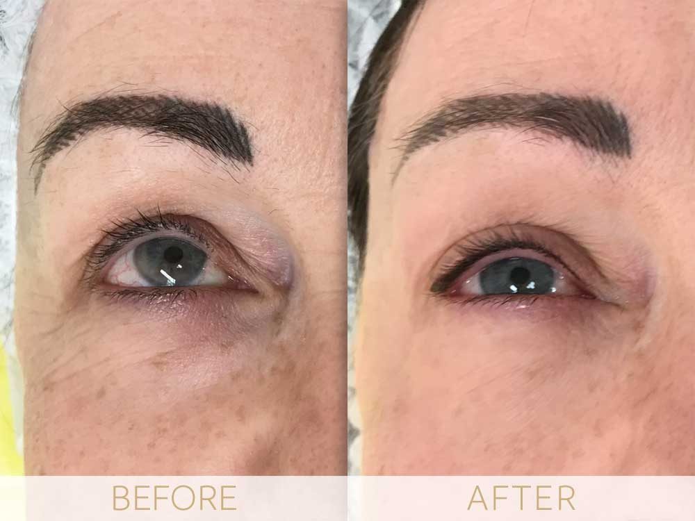 micropigmentation eye-ehancment, before & after