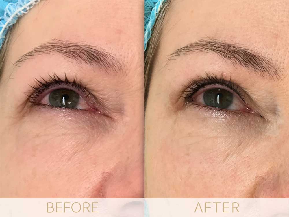 micropigmentation eye-ehancment, before & after