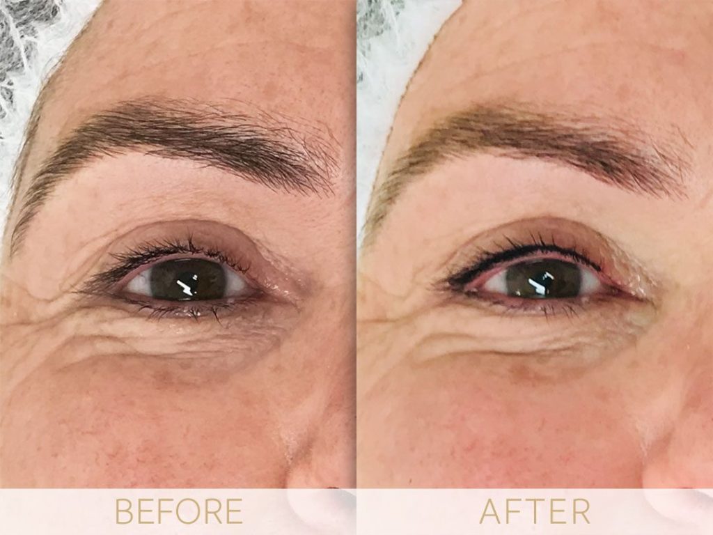 Micropigmentation before & after