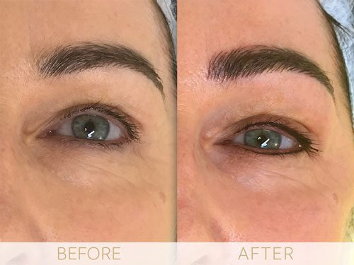 Micropigmentation before & after