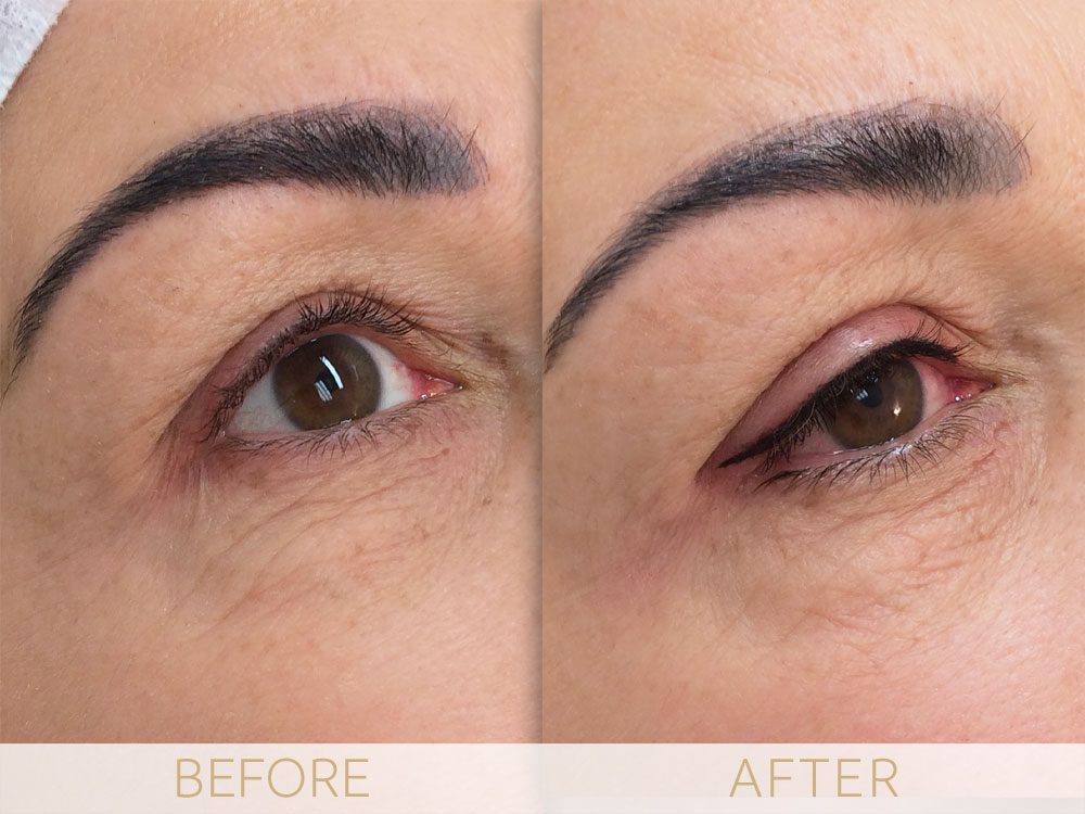 eye enhancement before & after