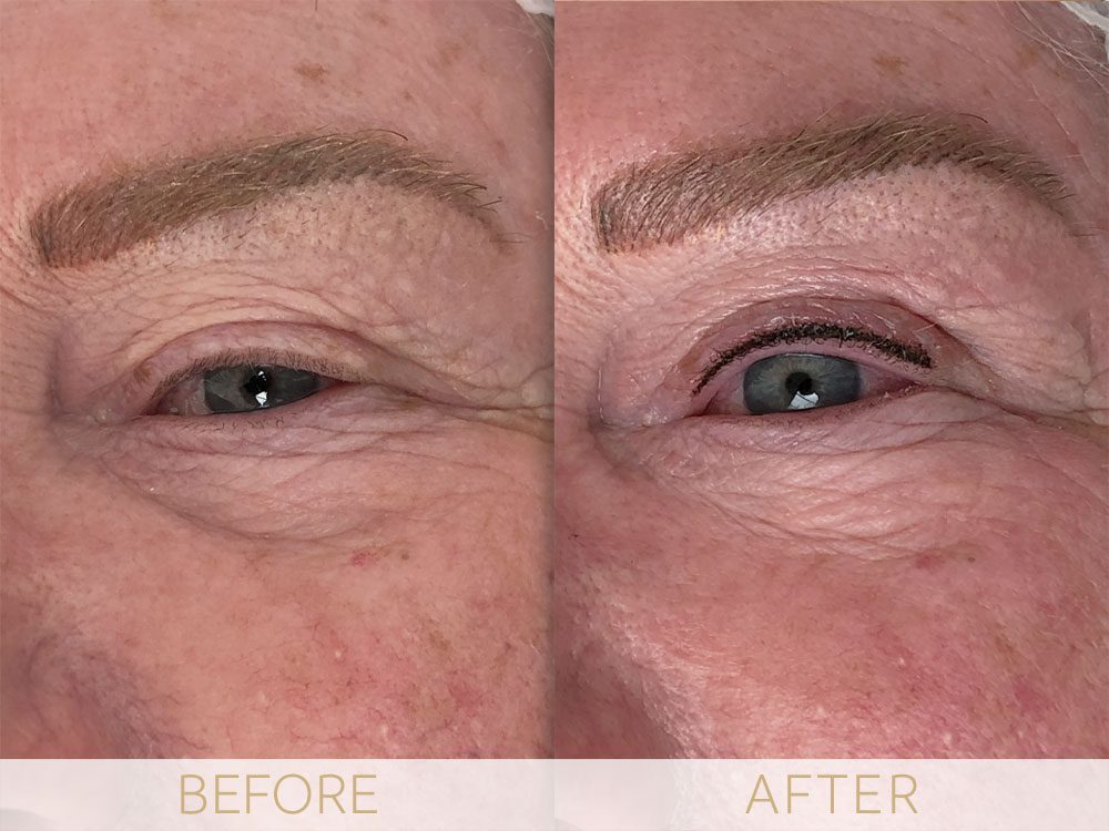 before and after eye enhancement