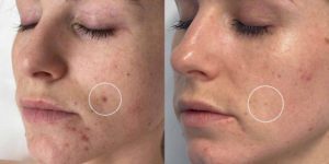 Acne before after treatment