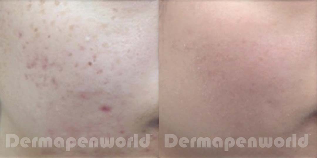 Dermapen pigmentation removal before & after