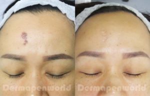 Dermapen pigmentation before & after