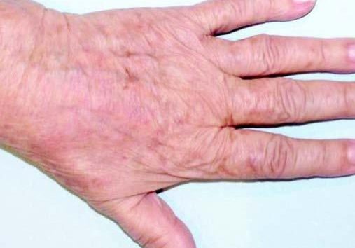 ALMA Rejuvenation Hand skin pigmentation removal—after