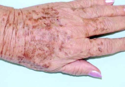 ALMA Rejuvenation Hand skin pigmentation removal—before