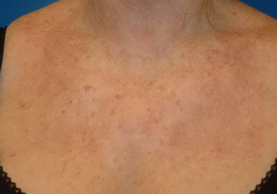 ALMA Rejuvenation decoletteskin pigmentation removal—after