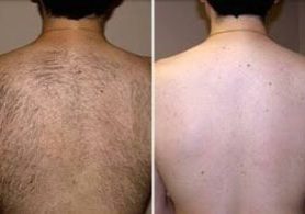 Alma IPL hair removal male back