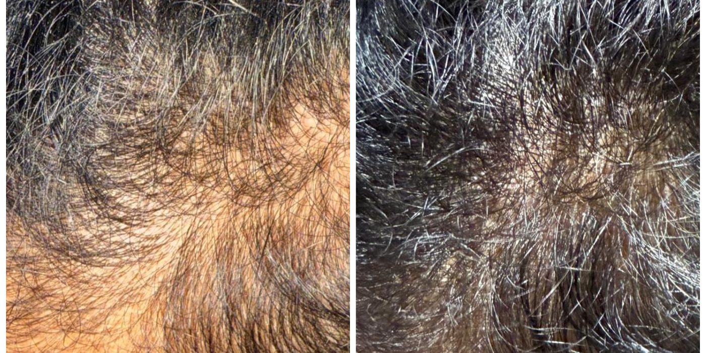B A_Hair-Loss-Female_19