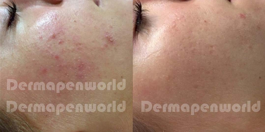 Dermapen pigmentation removal before & after
