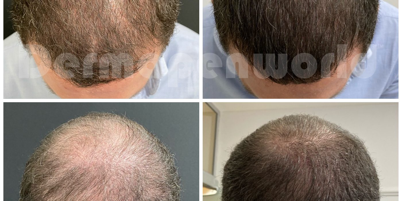 Before-and-After-Hair-Loss-Male-24