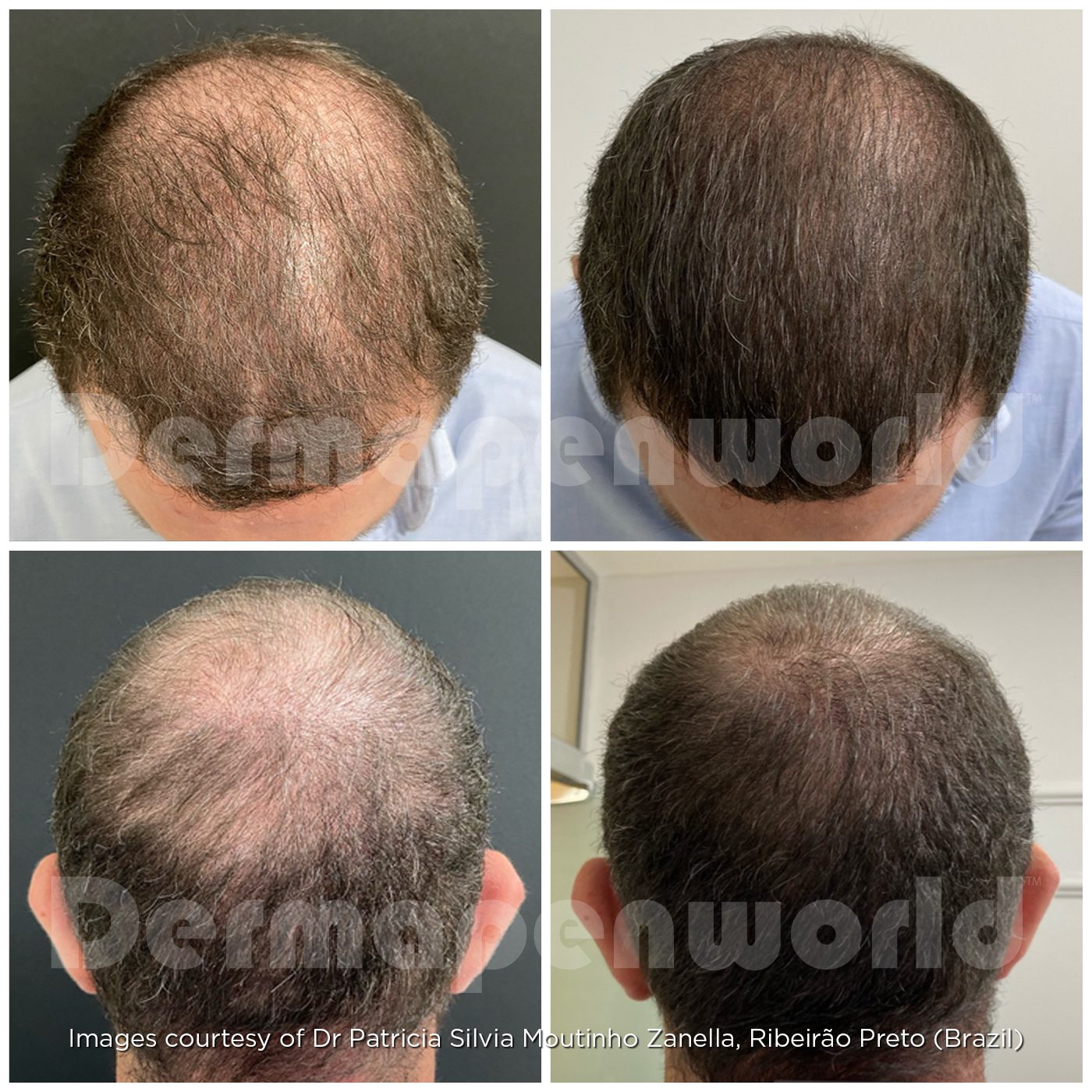 Before-and-After-Hair-Loss-Male-24