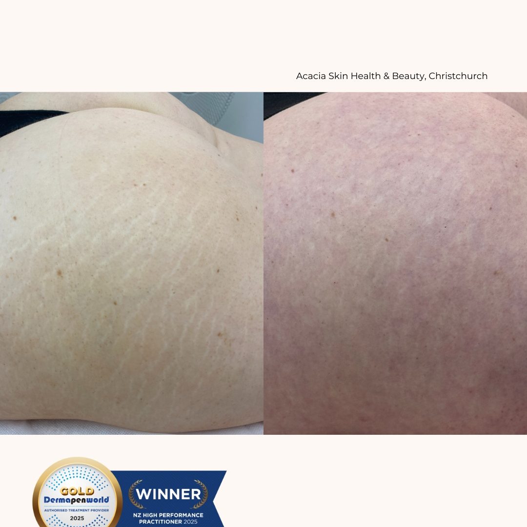 Dermapen Gold ATP - Winner - Acacia Skin Health & Beauty