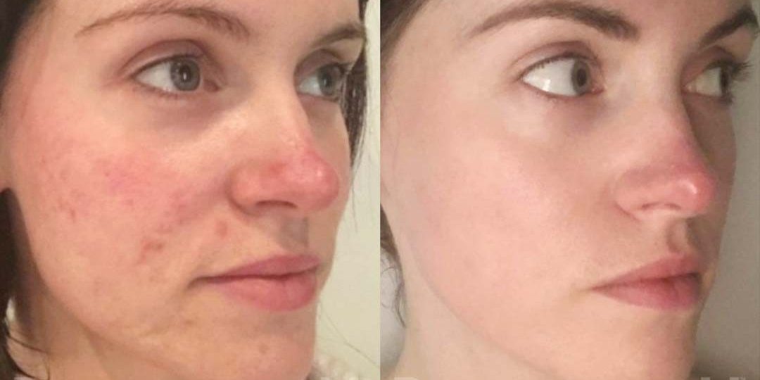 Dermapen pigmentation before & after acne