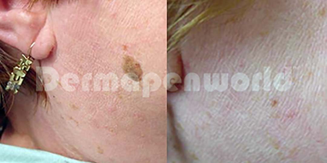 Dermapen Seborrheic Keratosis removal before & after